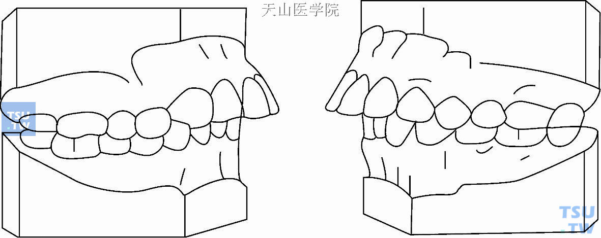 安氏第二类第一分类亚类