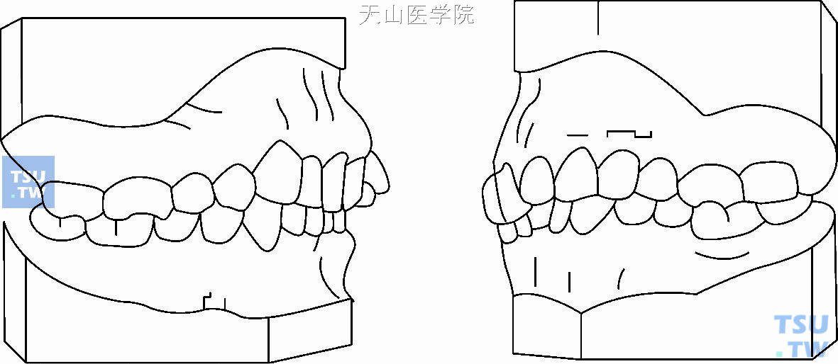 安氏第二类第二分类