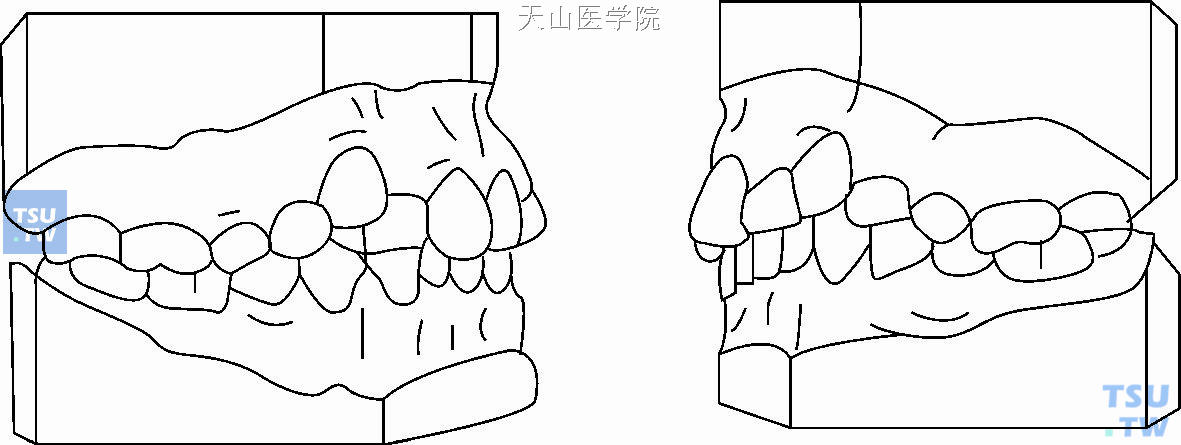 安氏第二类第二分类亚类