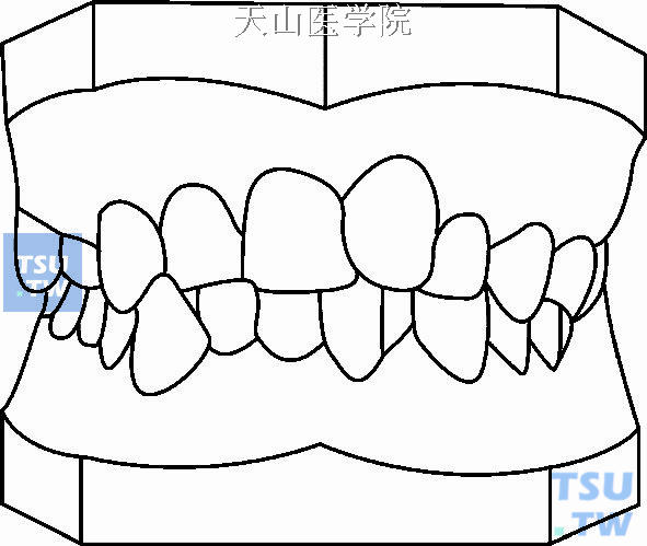 毛氏第一类第1分类（Ⅰ1）