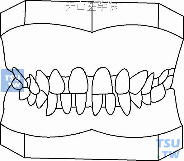 错牙合畸形的分类