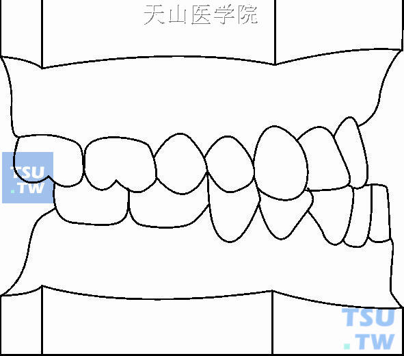 毛氏第二类第1分类（Ⅱ1）