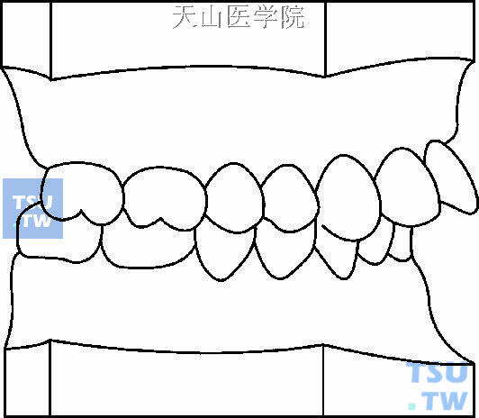 毛氏第二类第2分类（Ⅱ2）