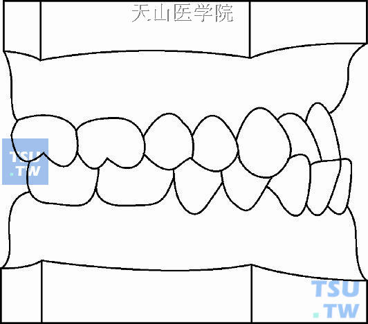 毛氏第二类第3分类（Ⅱ3）