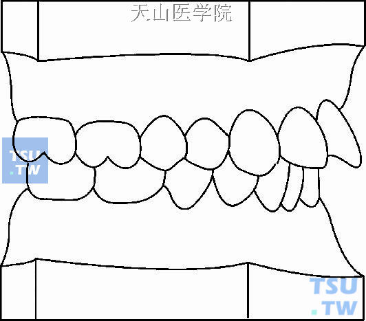 毛氏第二类第4分类（Ⅱ4）