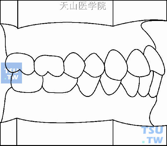 毛氏第二类第5分类（Ⅱ5）