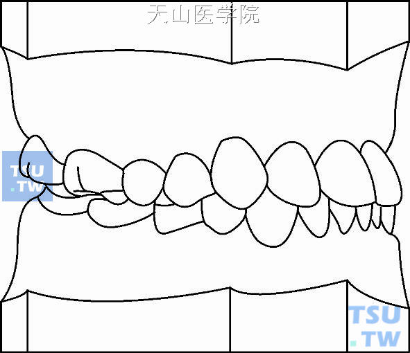 毛氏第三类第1分类（Ⅲ1）