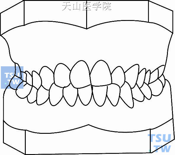 毛氏第三类第2分类（Ⅲ2）