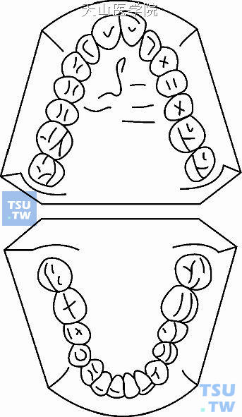 毛氏第三类第3分类（Ⅲ3）