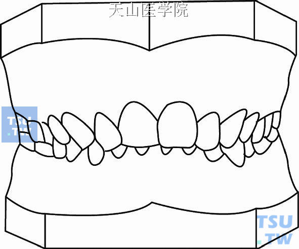 毛氏第四类第1分类（Ⅳ1）