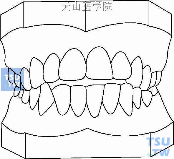 毛氏第四类第2分类（Ⅳ2）