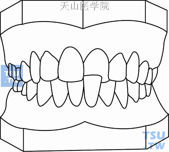 毛氏第五类牙合（Ⅴ）