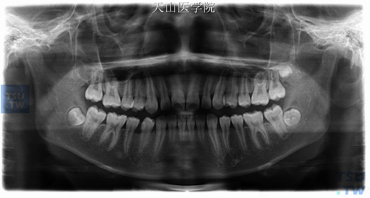 全颌曲面断层片