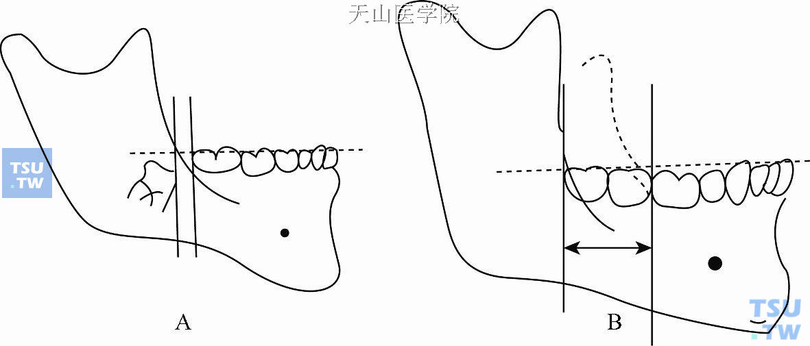 牙弓现有后段长度测量