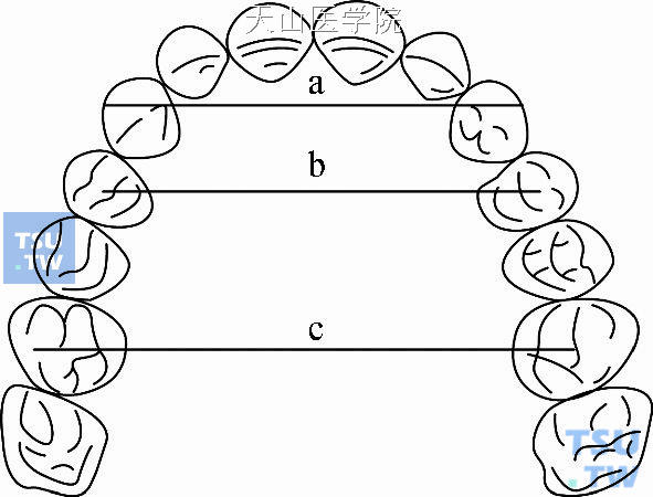 牙弓宽度的测量：a. 前段宽度；b. 中段宽度；c. 后段宽度