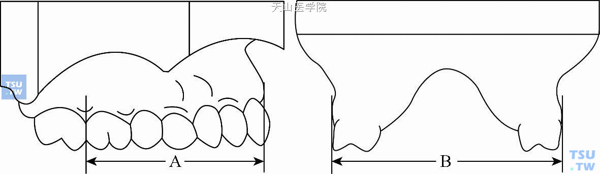 牙槽弓的长度和宽度：A. 牙槽弓长度；B. 牙槽弓宽度