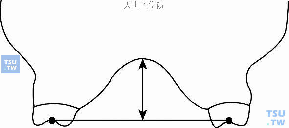 腭穹高度的测量