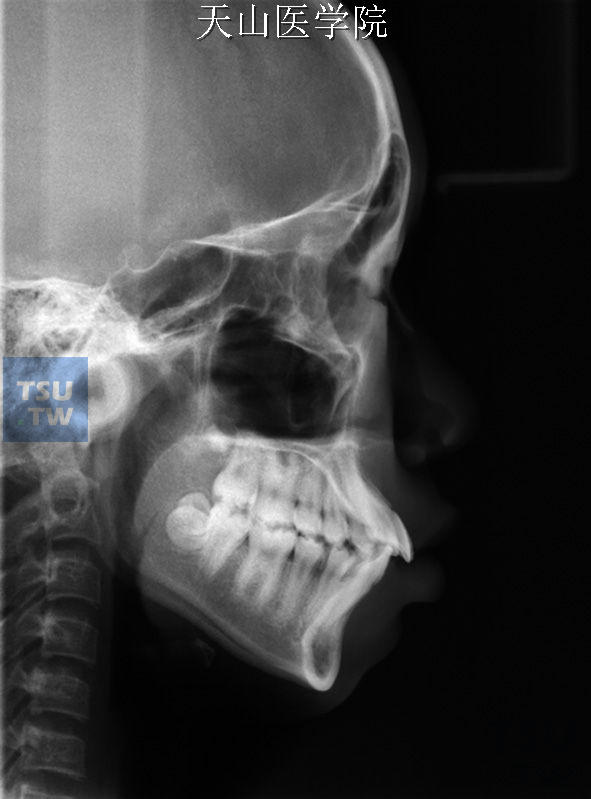 头颅定位X线侧位头影像