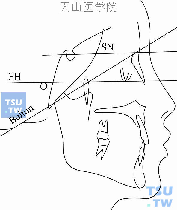 常用基准平面：SN：前颅底平面；FH：眼耳平面；Bolton：Bolton平面