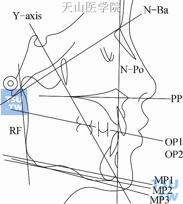 常用测量平面：N-Ba：全颅底平面；PP：腭平面；OP：牙合平面；MP：下颌平面；N-Po：面平面；RF：下颌支平面；Yaxis：Y轴