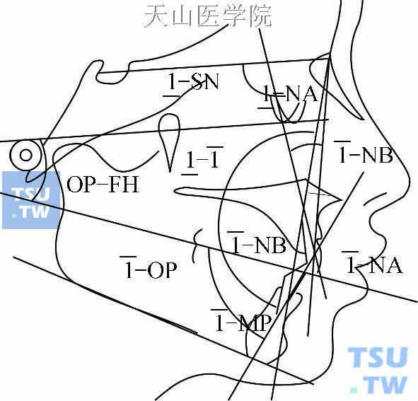 错牙合畸形的X线头影测量分析