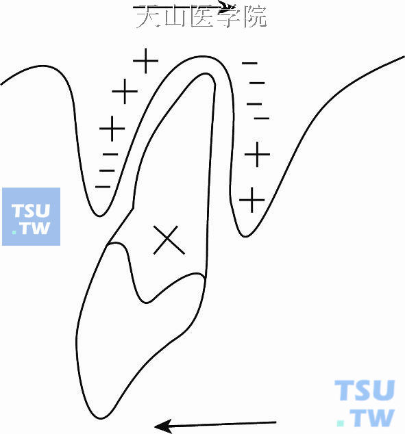 双根牙倾斜移动时，其牙周组织变化出现4个压力区和4个张力区。倾斜移动的最大压力与张力区是在牙根尖和牙颈部