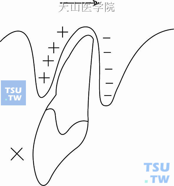 牙齿的转矩移动一般需要用固定矫治器才能完成，如方形弓丝在方形托槽沟中的转矩力等