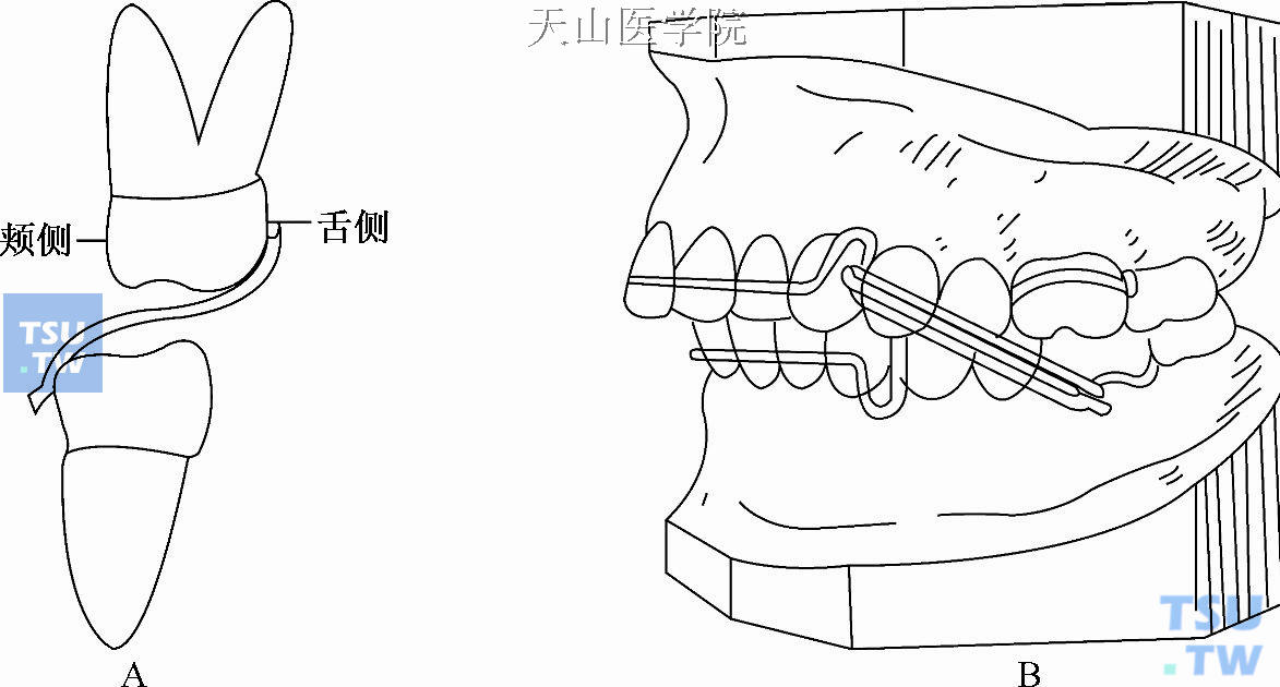 颌间支抗