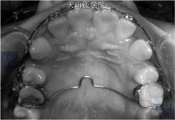 66间横腭杆加强支抗