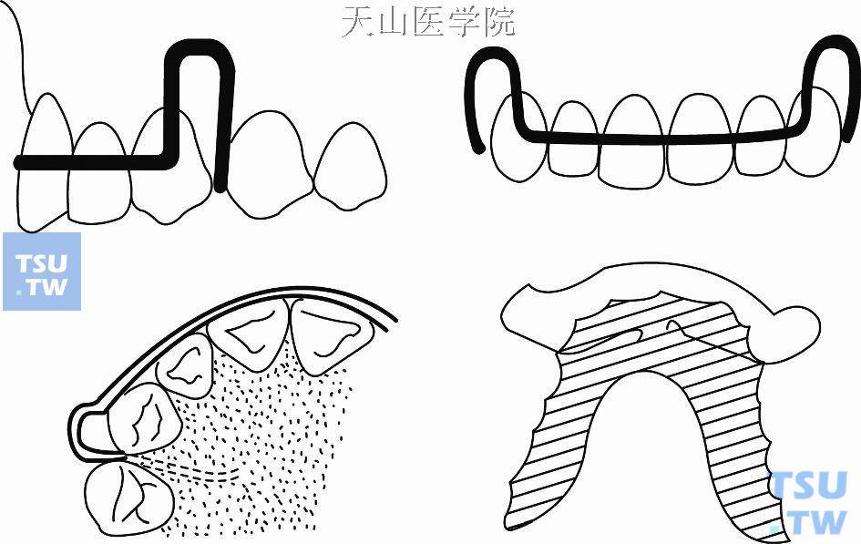 常用正畸活动矫治器基本构件的功能与弯制方法