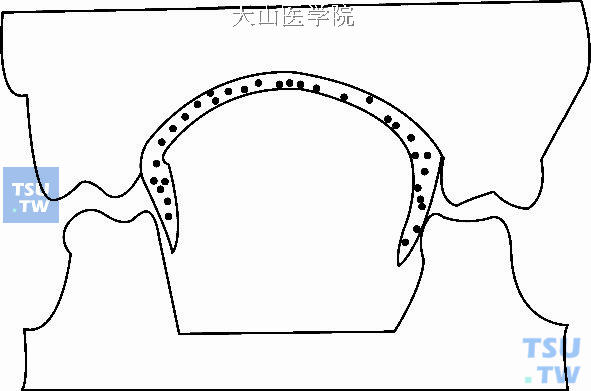 腭屏纠正侧方伸舌习惯