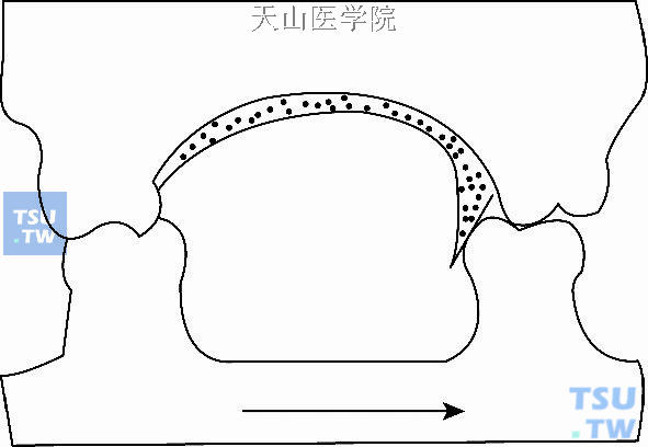 后牙斜面导板纠正偏侧咀嚼习惯