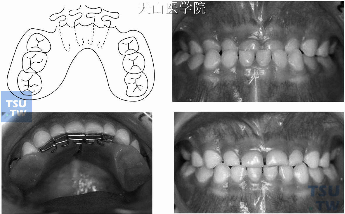 常用简单正畸活动矫治器的制作和应用