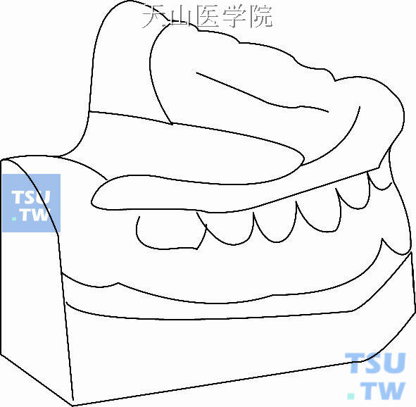 下颌牙合垫式矫治器