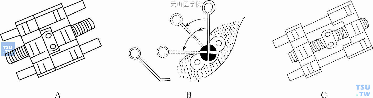 螺旋扩弓器