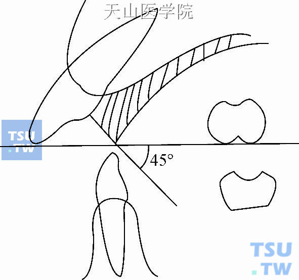 上颌斜面导板斜面角度