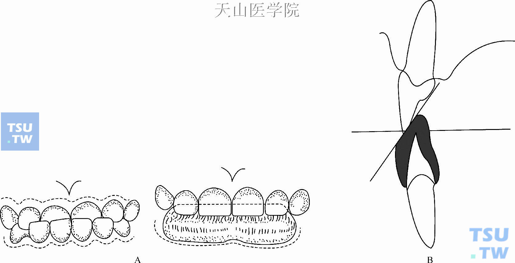 下前牙塑料联冠斜面导板