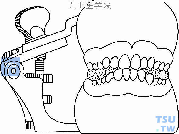 肌激动器侧方上牙合架