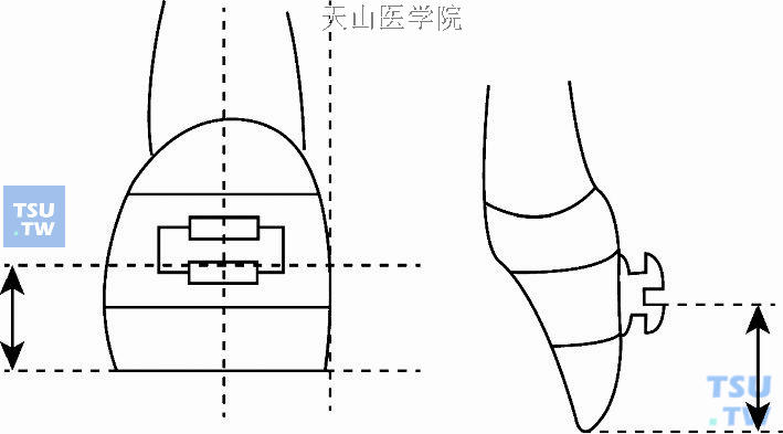 托槽在牙面上的轴倾度