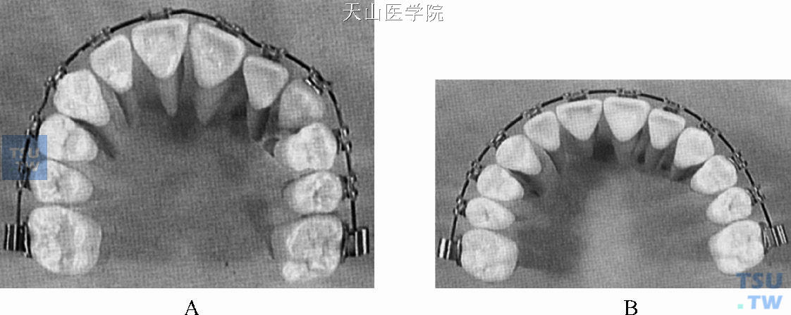 排齐牙齿