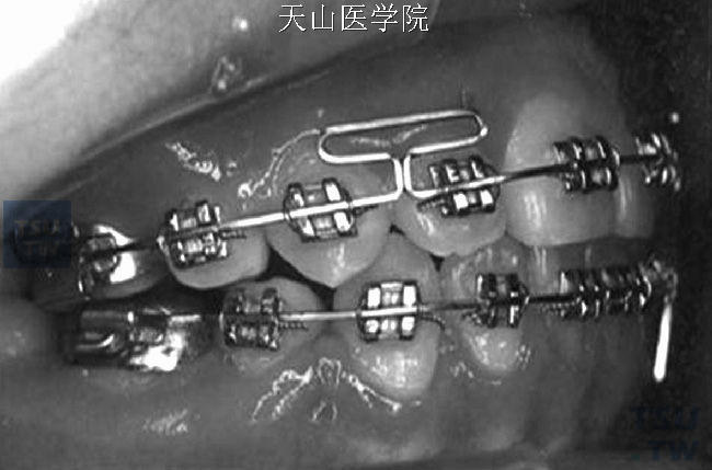 正畸固定矫治器：方丝弓矫治器和矫治技术