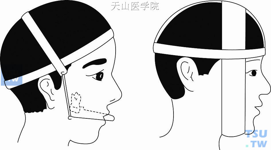 垂直牵引压低后牙高度