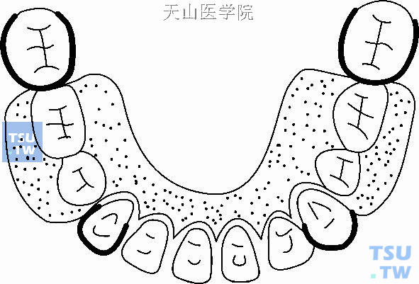 活动义齿式缺隙保持器