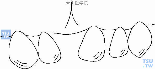 上恒中切牙早失后缺隙两侧的牙齿向缺隙区倾斜、移位