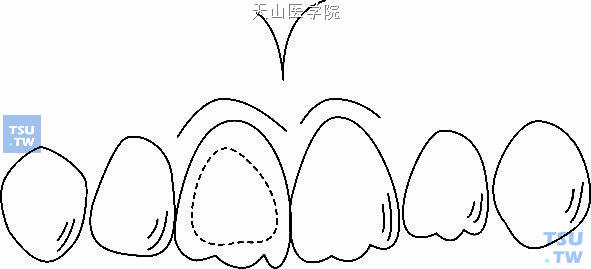 上恒中切牙早失，将侧切牙、尖牙及前磨牙等前移并结合改形和修复恢复牙弓的完整