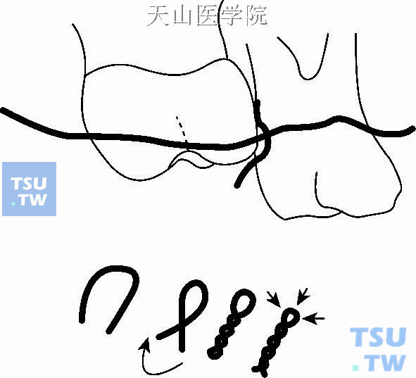 利用结扎紧的黄铜丝改变其萌出道，使第一磨牙正常萌出