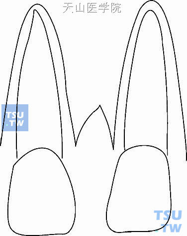 上中切牙间腭中缝处的牙槽嵴有“V”形缺口