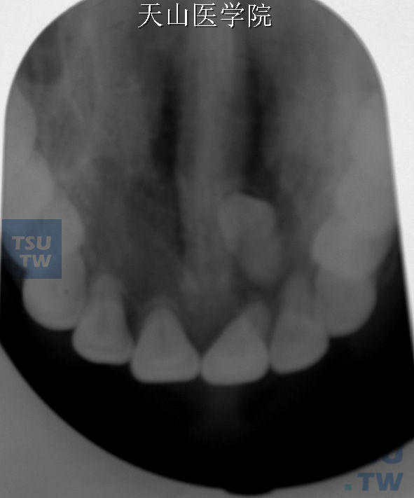 中切牙区的多生牙