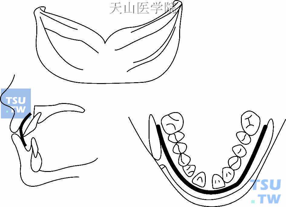 　前庭盾