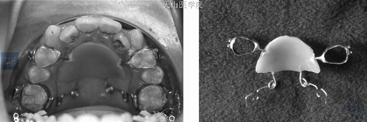 骨量与牙量不调的正畸矫正